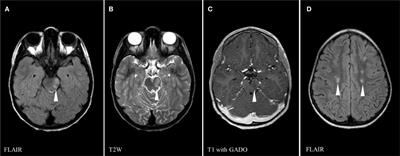 Acute Hemorrhagic Encephalitis Responding to Combined Decompressive Craniectomy, Intravenous Immunoglobulin, and Corticosteroid Therapies: Association with Novel RANBP2 Variant